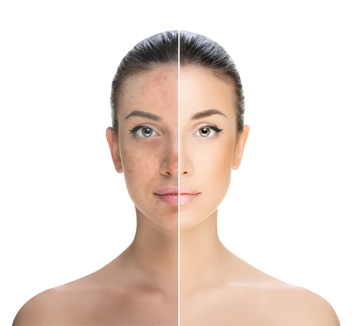 Pigmentation Solutions