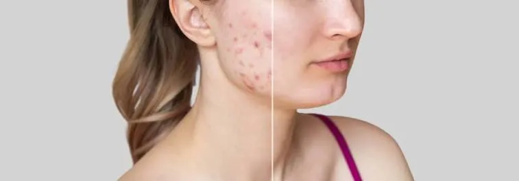 Scar Care